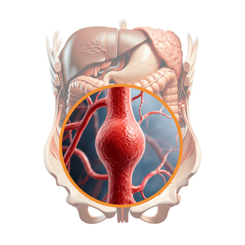 Modellzeichnung eines Aneurysma